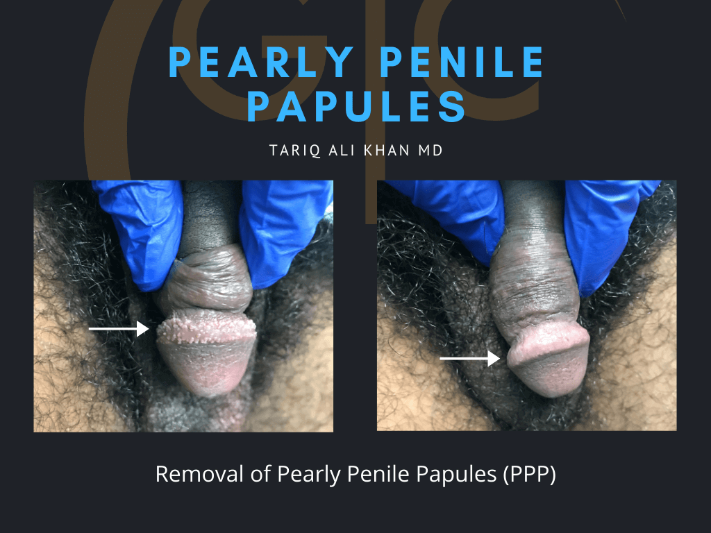 Gentle Care Laser Tustin & Long Beach Before and After picture - pearly penile papules